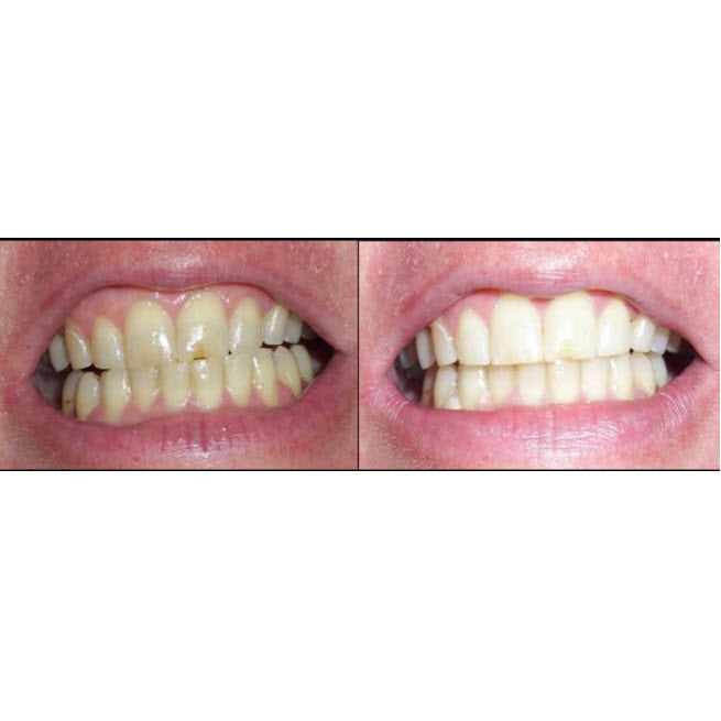 Professional Quality Home Teeth Whitening Kit