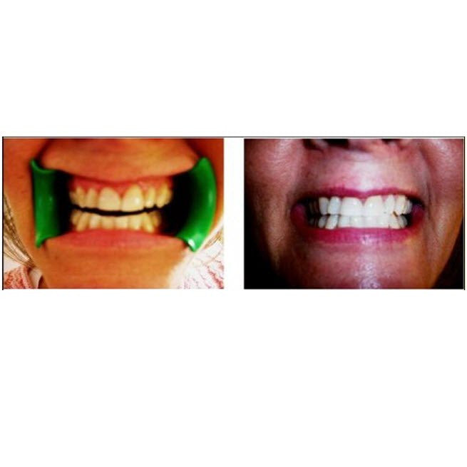 Professional Quality Home Teeth Whitening Kit