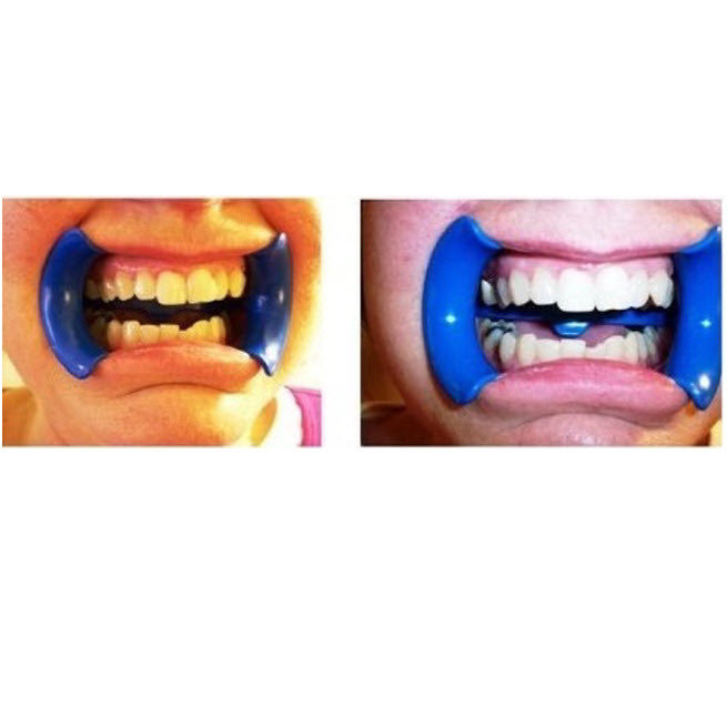 Professional Quality Home Teeth Whitening Kit